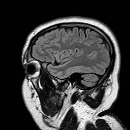 File:Neuro-Behcet's disease (Radiopaedia 21557-21506 Sagittal FLAIR 6).jpg