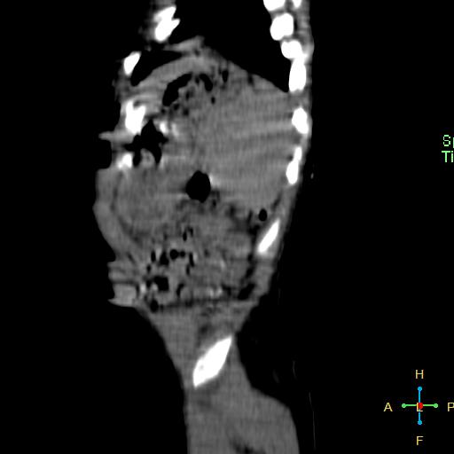 File:Neuroblastoma (Radiopaedia 24751-25016 C 1).jpg