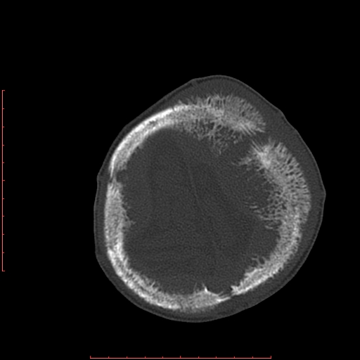 File:Neuroblastoma skull metastasis (Radiopaedia 56053-62683 Axial bone window 23).jpg