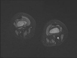 File:Neuroblastoma with bone metastases (Radiopaedia 67080-76414 Axial STIR 12).jpg