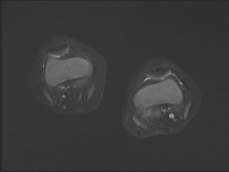 File:Neuroblastoma with bone metastases (Radiopaedia 67080-76414 Axial STIR 9).jpg