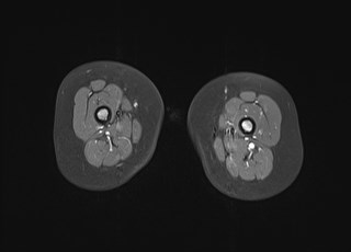 File:Neuroblastoma with bone metastases (Radiopaedia 67080-76414 Axial T1 C+ fat sat 26).jpg