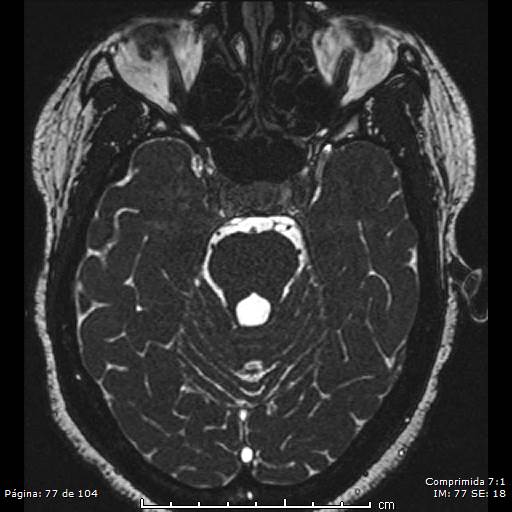 Neurocysticercosis (Radiopaedia 58636-65832 I 77).jpg