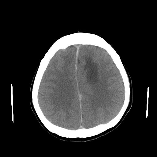 File:Neurofibromatosis type 2 (Radiopaedia 25389-25637 Axial non-contrast 19).jpg