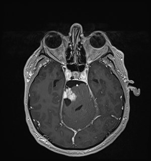 Neurofibromatosis type 2 (Radiopaedia 79097-92049 Axial T1 C+ 74).jpg