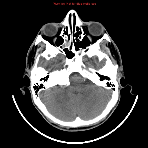 File:Neurofibromatosis type 2 (Radiopaedia 8953-9732 Axial non-contrast 7).jpg