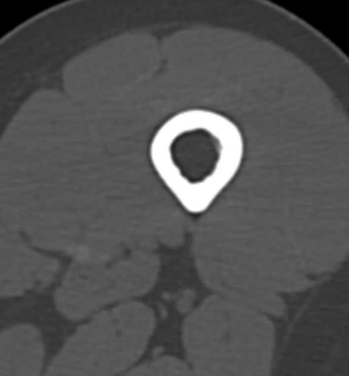 Non-ossifying fibroma - femur (Radiopaedia 82786-97042 Axial bone window 13).jpg