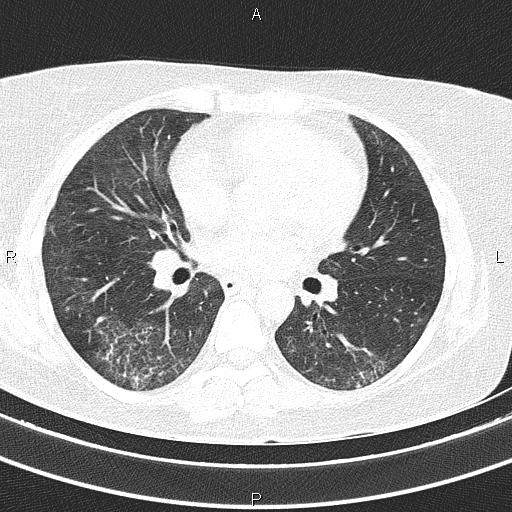 Non-specific interstitial pneumonia (Radiopaedia 83185-97567 Axial lung window 36).jpg