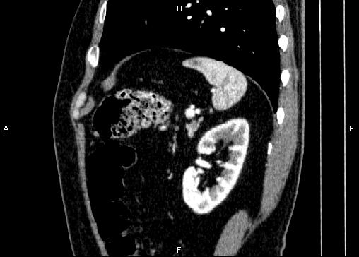 Non-syndromic pancreatic endocrine tumor (Radiopaedia 86958-103178 E 79).jpg