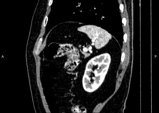 Non-syndromic pancreatic endocrine tumor (Radiopaedia 86958-103178 E 83).jpg