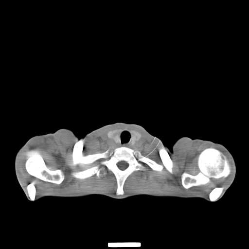 File:Non hodgkin lymphoma of the mediastinum (Radiopaedia 20814-20729 Axial non-contrast 2).jpg