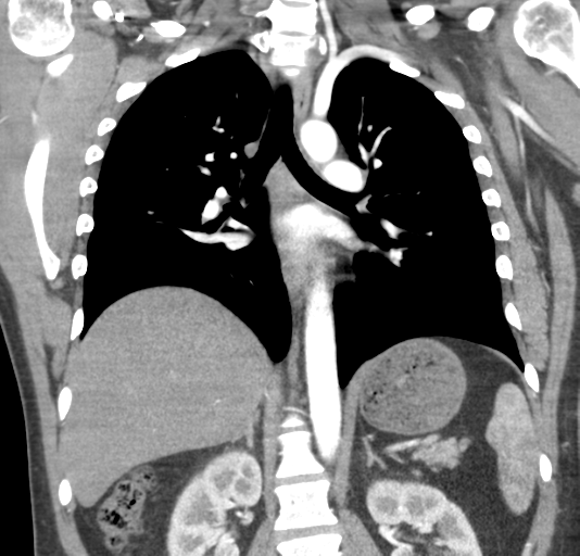 File:Normal CTA thorax (non ECG gated) (Radiopaedia 41750-44704 B 53).png