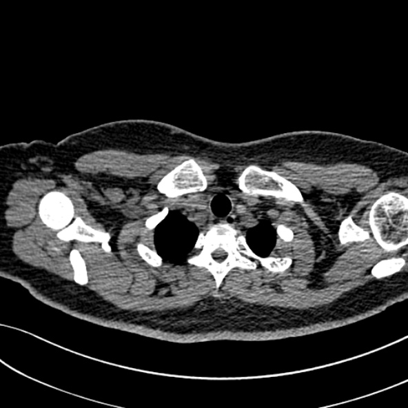Normal CT chest- adult female (Radiopaedia 52522-58428 Axial non-contrast 16).jpg
