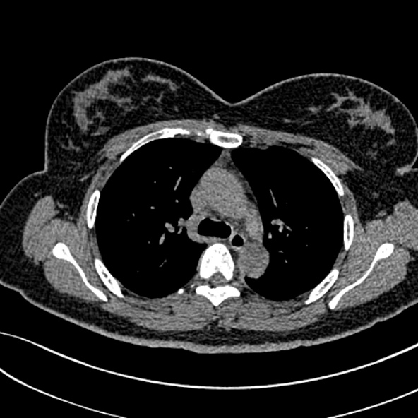 Normal CT chest- adult female (Radiopaedia 52522-58428 Axial non-contrast 48).jpg