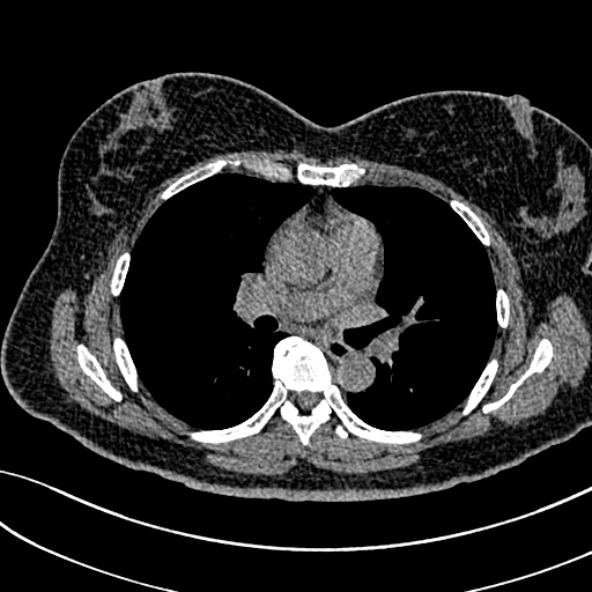 Normal CT chest- adult female (Radiopaedia 52522-58428 Axial non-contrast 62).jpg