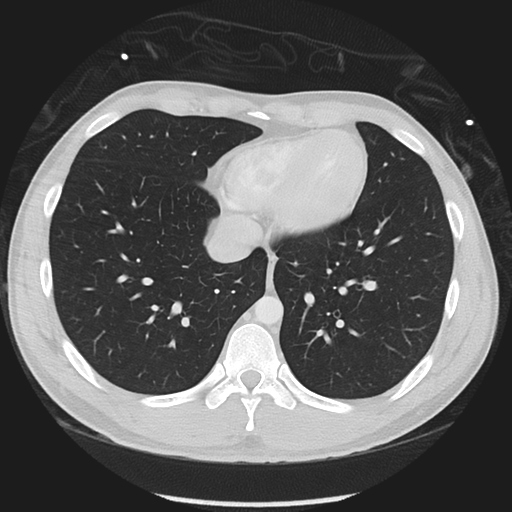 Normal CT pulmonary veins (pre RF ablation) (Radiopaedia 41748-44702 Axial lung window 44).png