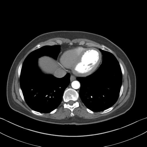File:Normal CT renal artery angiogram (Radiopaedia 38727-40889 A 4).png