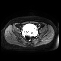 Normal MRI abdomen in pregnancy (Radiopaedia 88005-104548 Axial DWI 20).jpg