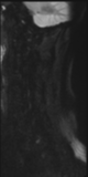 File:Normal MRI cervical spine (infection protocol) (Radiopaedia 53916-60039 Sagittal DWI 18).png