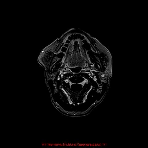 Normal adult brain MRI (non-enhanced and contrast-enhanced) (Radiopaedia 75262-86379 Axial T1 C+ 10).jpg
