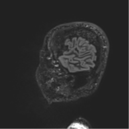 Normal brain MRI (non-focal epilepsy protocol) (Radiopaedia 53917-60040 Sagittal DIR 10).png