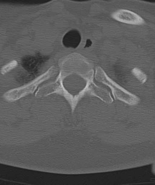 Normal cervical spine MRI (including Dixon) (Radiopaedia 42762-45926 Axial bone window 53).png