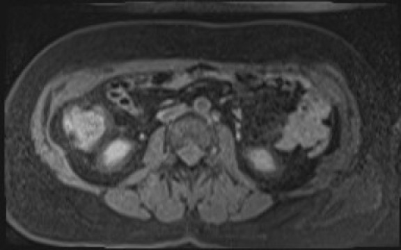 File:Normal hepatobiliary phase liver MRI (Radiopaedia 58968-66230 A 79).jpg