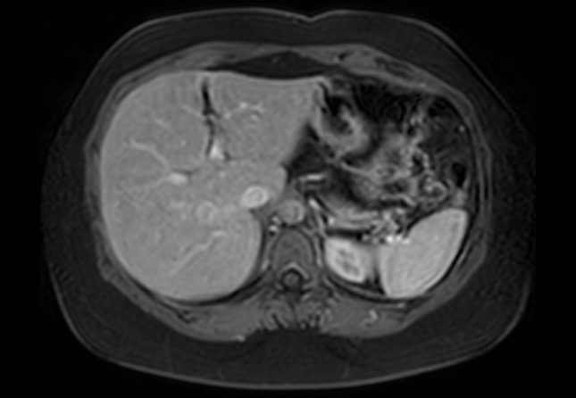 Normal liver MRI with Gadolinium (Radiopaedia 58913-66163 J 50).jpg