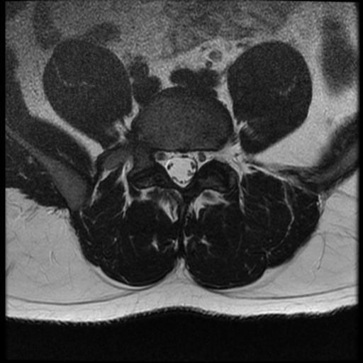 File:Normal lumbar spine MRI (Radiopaedia 35543-37039 Axial T2 12).png