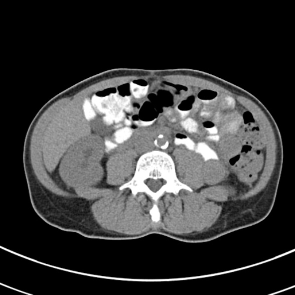 File:Normal multiphase CT liver (Radiopaedia 38026-39996 Axial non-contrast 45).jpg