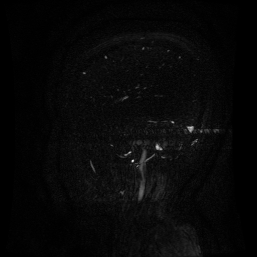 Normal noncontrast MR venography (Radiopaedia 87578-103957 A 35).jpg