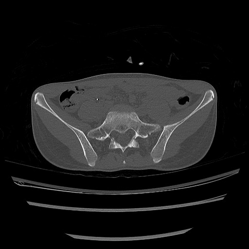 Normal pelvis CT (Radiopaedia 51471-57236 Axial bone window 23).jpg