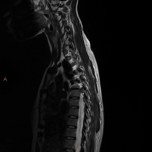 File:Normal spine MRI (Radiopaedia 77323-89408 E 4).jpg