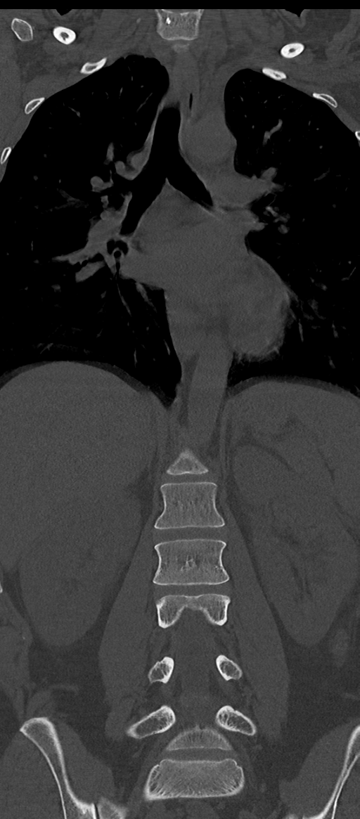 Normal thoracolumbar spine (Radiopaedia 43822-47309 Coronal bone window 41).png
