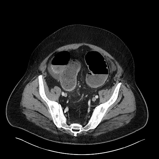 Obstructing sigmoid adenocarcinoma (Radiopaedia 58465-65619 A 131).jpg