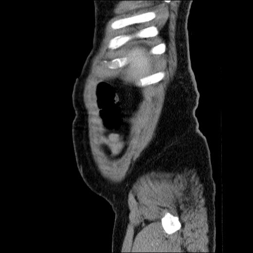 Obstructing ureteric calculus (Radiopaedia 49281-54373 C 14).jpg