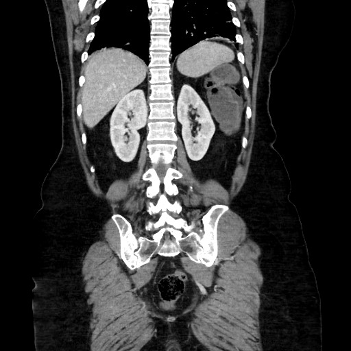 Obstructive distal colonic adenocarcinoma causing cecal perforation (Radiopaedia 86830-102989 C 129).jpg