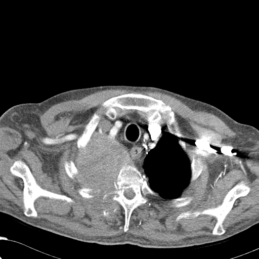 File:Obstructive superior vena cava tumor thrombus (Radiopaedia 28046-28306 A 7).jpg