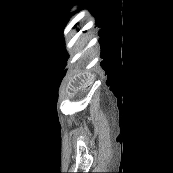 Obturator hernia causing small bowel obstruction (Radiopaedia 65522-74612 C 8).jpg
