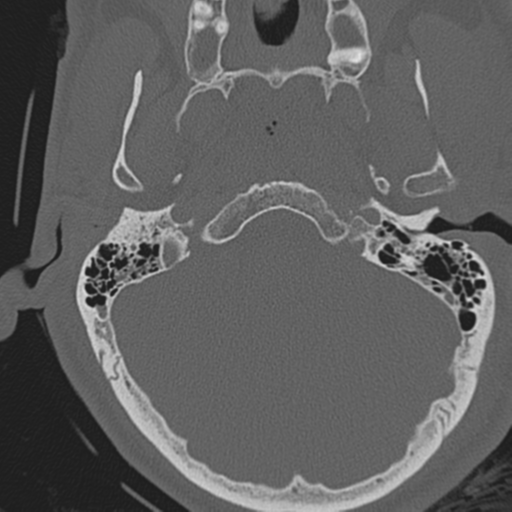 File:Occipital condyle fracture (Radiopaedia 33467-34517 Axial bone window 11).png