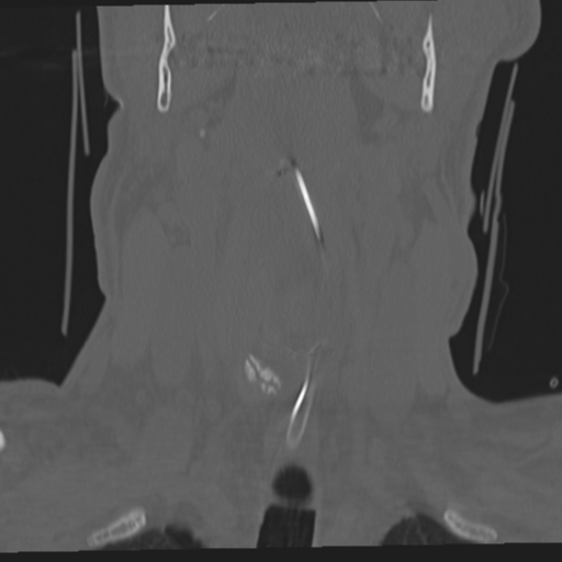 File:Occipital condyle fracture (Radiopaedia 33467-34517 Coronal bone window 15).png