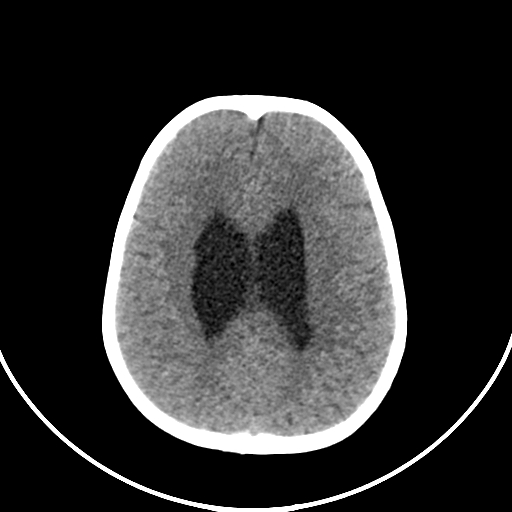 Occipital encephalocele (Radiopaedia 87339-103636 Axial non-contrast 59).jpg