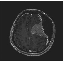 Image revealed a bilateral frontoparietal bone hyperostosis, particularly in the left side