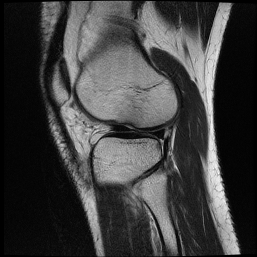 File:ACL acute full thickness tear - deep lateral femoral sulcus sign (Radiopaedia 38594-40740 Sagittal T2 17).jpg