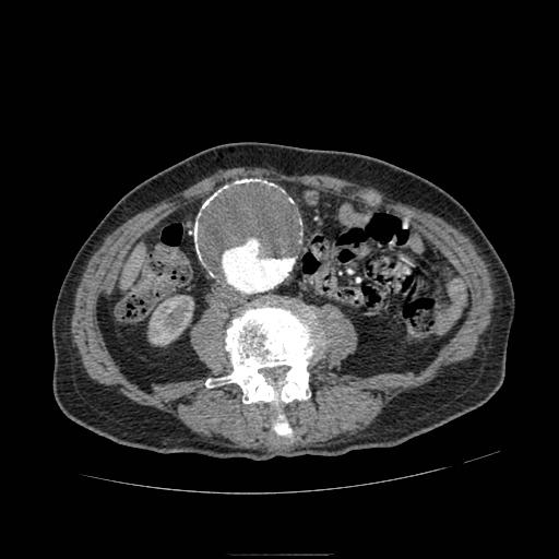 Abdominal aortic aneurysm (Radiopaedia 13341-13340 Axial C+ arterial phase 116).jpg