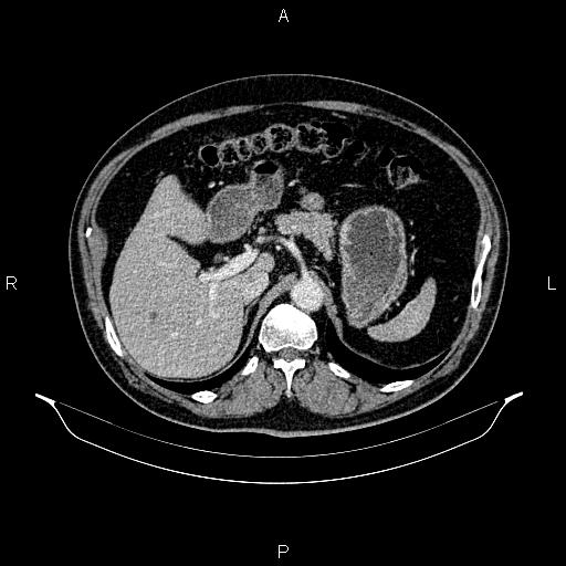 Abdominal aortic aneurysm (Radiopaedia 83094-97462 Axial renal cortical phase 79).jpg