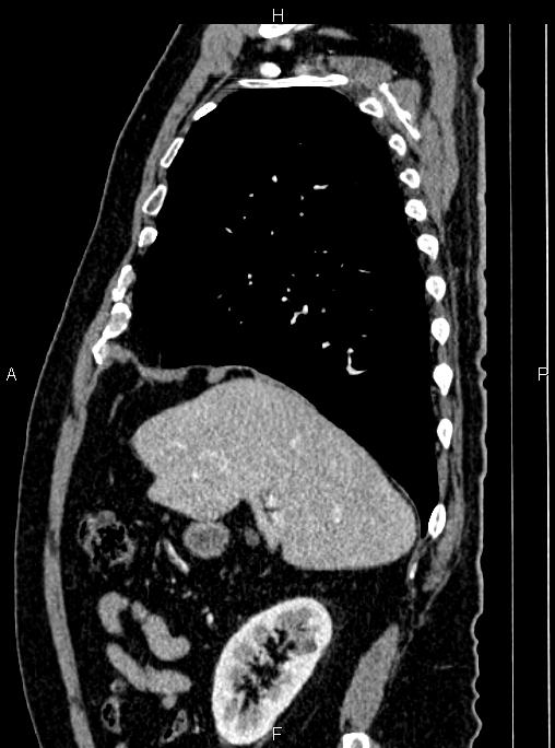 Abdominal aortic aneurysm (Radiopaedia 83094-97462 Sagittal renal cortical phase 39).jpg