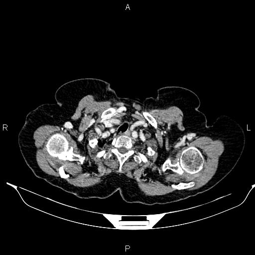 File:Abdominal aortic aneurysm (Radiopaedia 85063-100606 Axial C+ portal venous phase 6).jpg