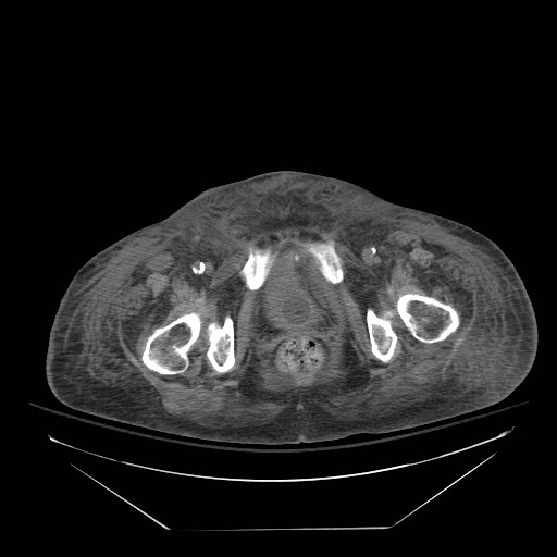 Abdominal aortic aneurysm - impending rupture (Radiopaedia 19233-19247 Axial non-contrast 164).jpg