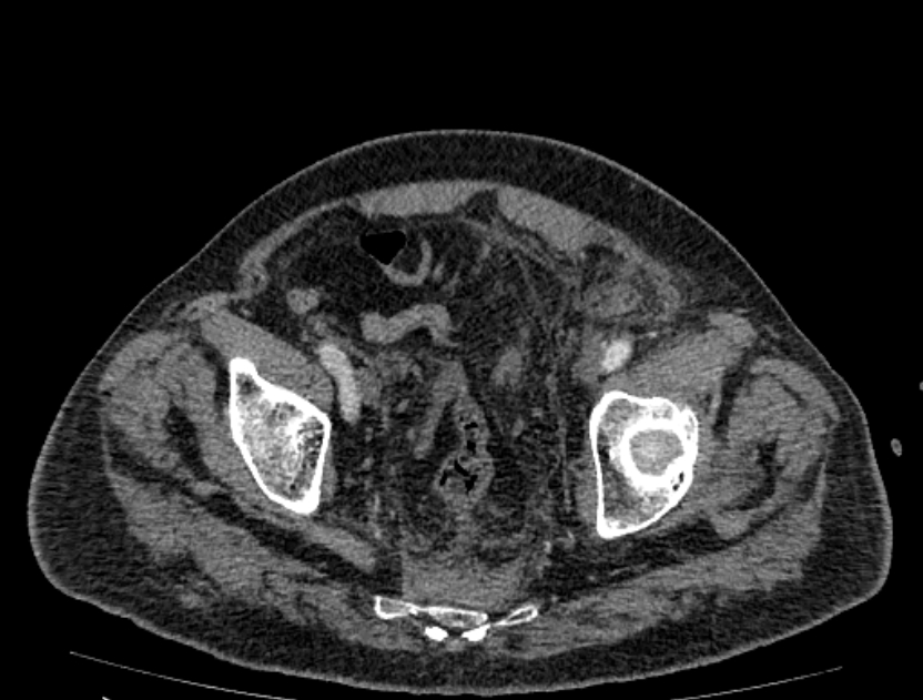 Abdominal aortic aneurysm rupture (Radiopaedia 54179-60362 Axial C+ arterial phase 50).jpg